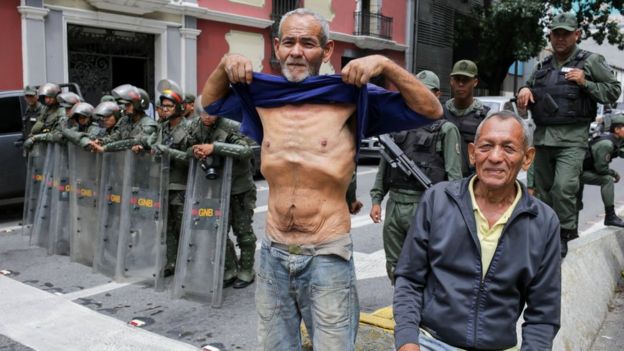 Venezolano mostrando su estado de desnutriciÃ³n