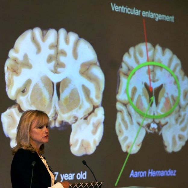 Ann McKee ante una presentación del cerebro de Aaron Hernandez