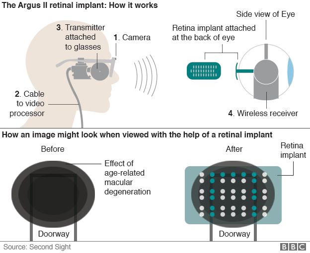 Infographic showing how bionic eye works and what it can see