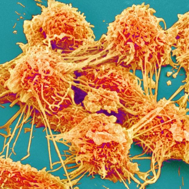 خلايا سرطانية في قولون مريض