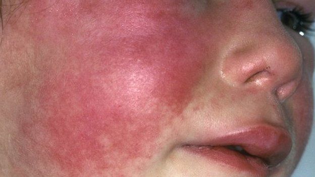 Scarlet fever on child's face