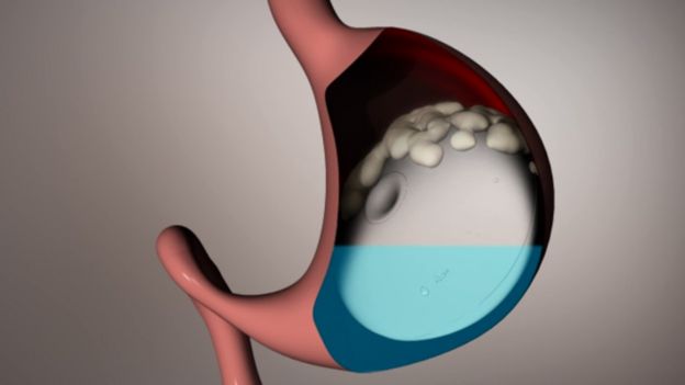 Balon gastrico para bajar de peso precio