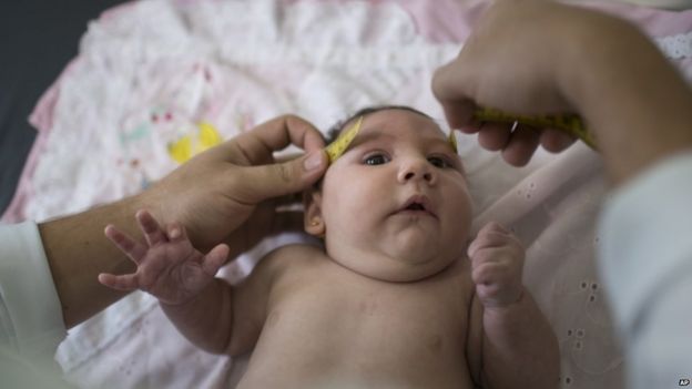 Zika linked to baby joint deformities - BBC News