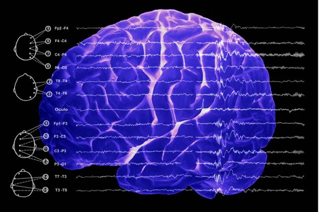 Resonancia magnética del cerebro.