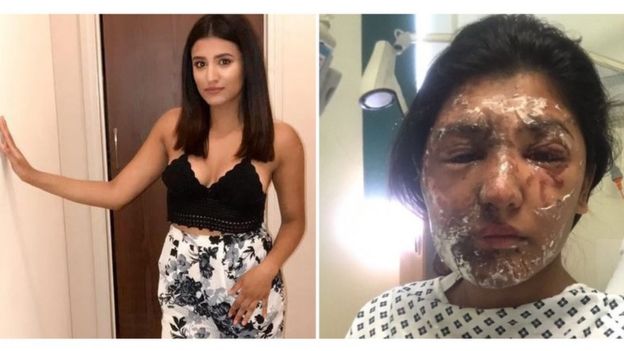 Imágenes del antes y del después del ataque con ácido a Resham Khan.