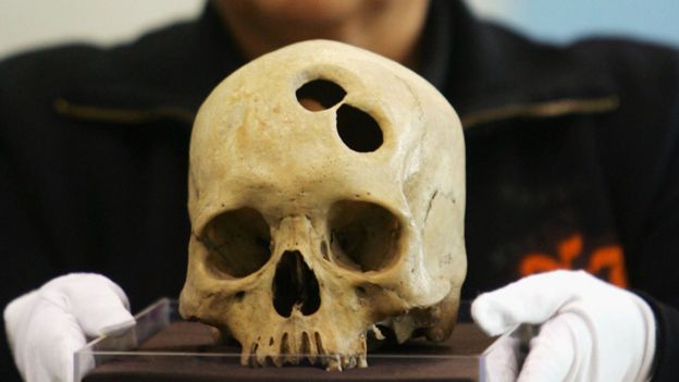 El cráneo perforado de una mujer inca