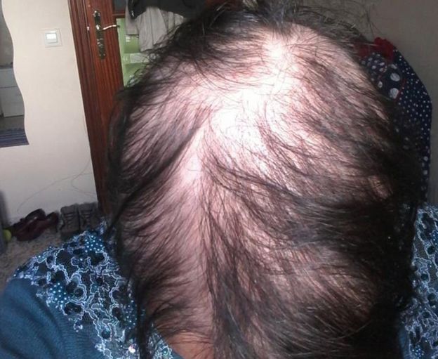 Josie Sinnadurai showing hair loss