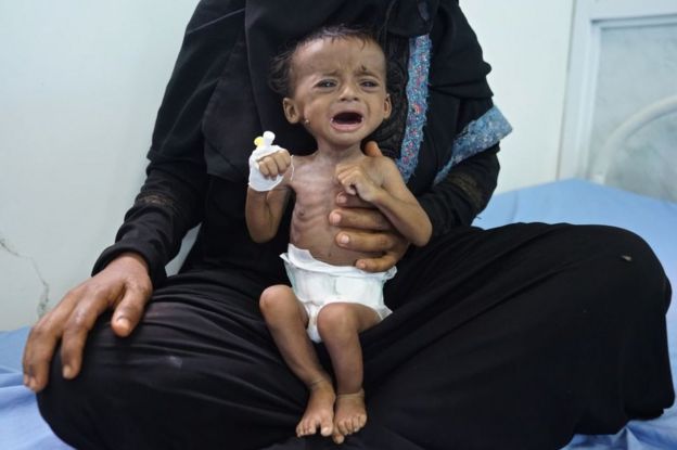 A Yemeni child suffering from severe acute malnutrition