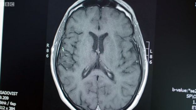 Escáner cerebral de Stephen Storey posterior al tratamiento con células madre.