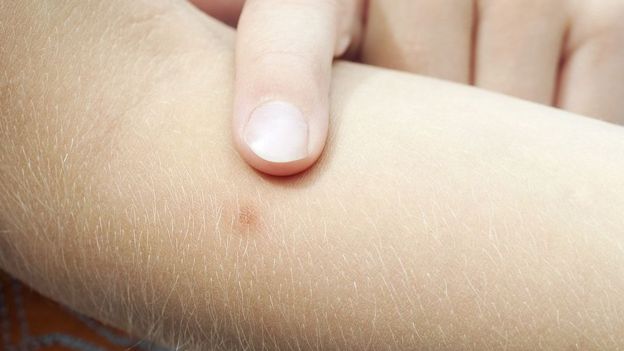 Una picadura de mosquito en un brazo