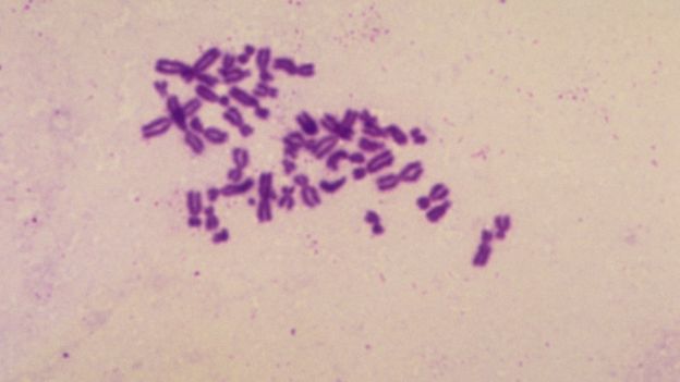 Cromosomas de un paciente con síndrome de Turner.