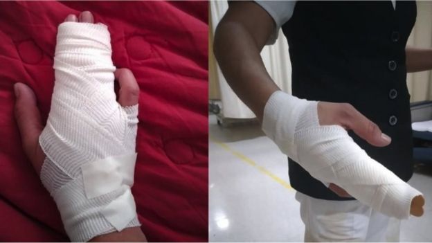 Imágenes de la mano fracturada por una enfermera agredida
