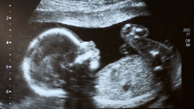 Ultrasonida de un feto