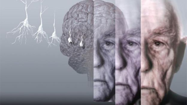 Картинки по запросу Альцгеймера