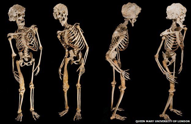 four views of Joseph Merrick's skeleton