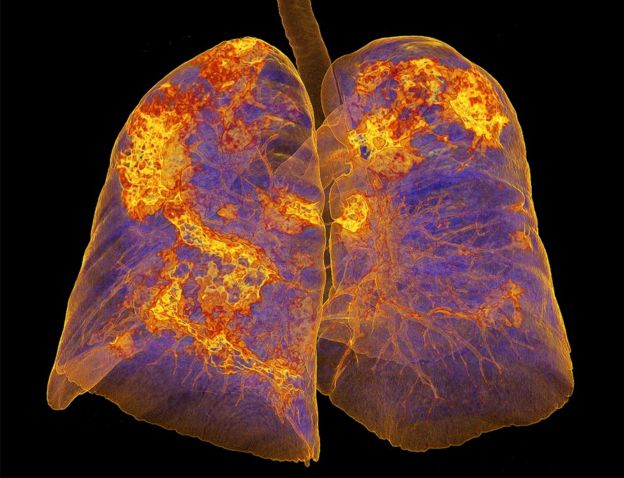 Coronavirus can cause viral pneumonia which requires treatment in hospital.