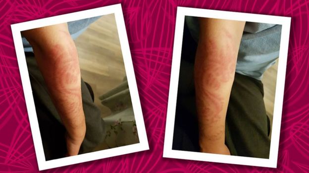 Cicatriz del tatuaje de dragón que le hicieron a Alex con henna negra.