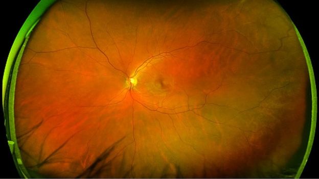 Escáner de retina