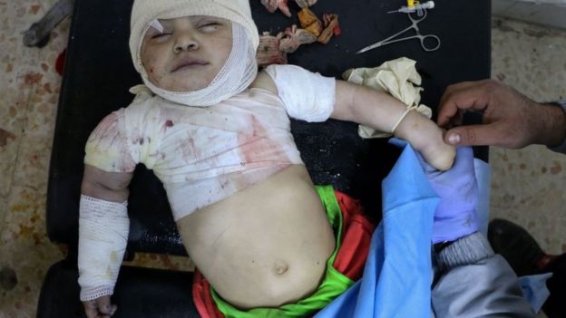சிரியாவில் போரில் பாதிக்கப்பட்ட குழந்தை