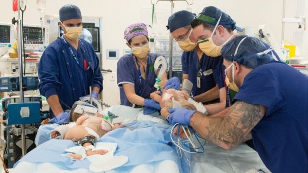 Imagem mostra cinco profissionais observando bebê após separação cirúrgica
