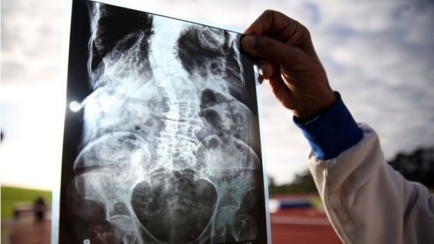 The x-ray of 101-year-old Man Kaur of India is viewed prior to her competing in the 100m sprint in the 100+ age category at the World Masters Games at Trusts Arena in Auckland on April 24, 2017