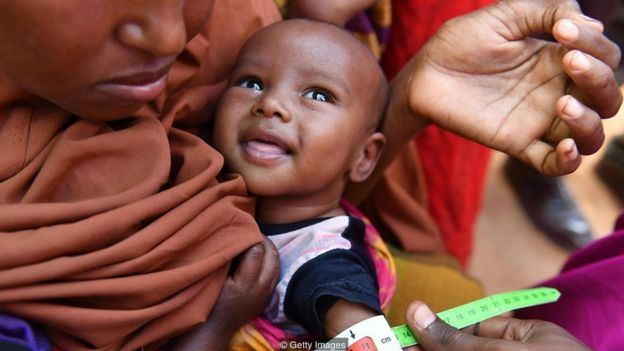 41+ Gambar Anak Kecil Kurang Gizi Gratis Terbaik
