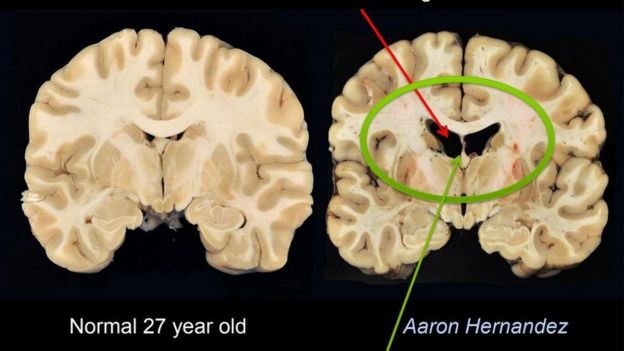 A diferencia de los que sería un cerebro normal de una persona de 27 años, el de Hernández presentaba grandes cavidades y tejido atrofiado. 