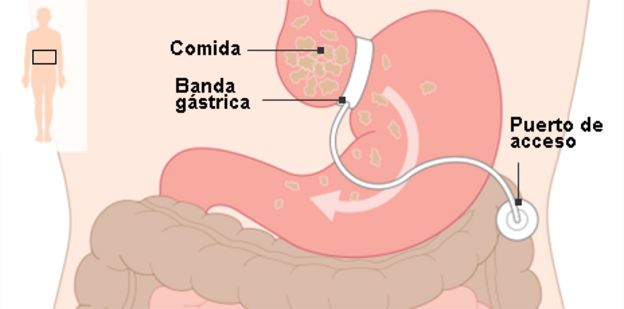 Cirugía bariátrica