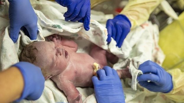 Indy Pearl Edwards recém-nascida no parto, assistida por mãos da equipe médica
