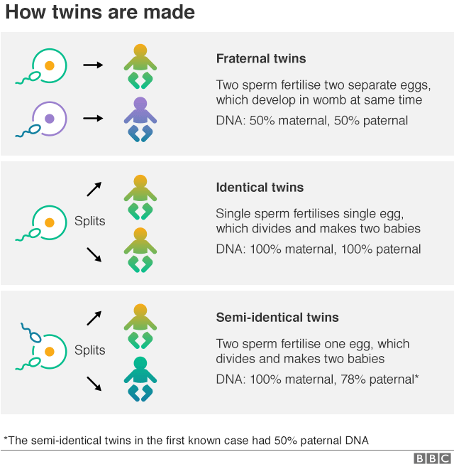 Semi Identical Twins Identified For Only The Second Time Bbc News