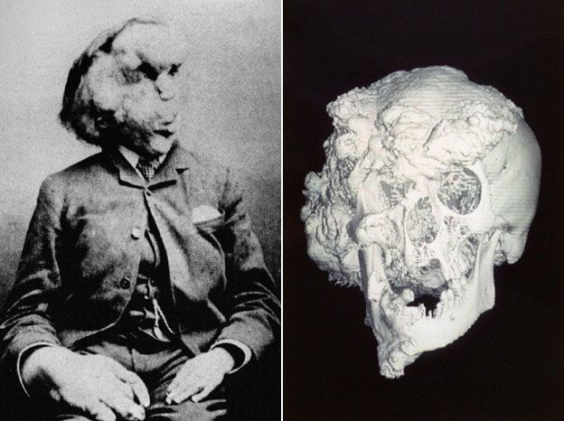 Photo of Joseph Merrick and his skull