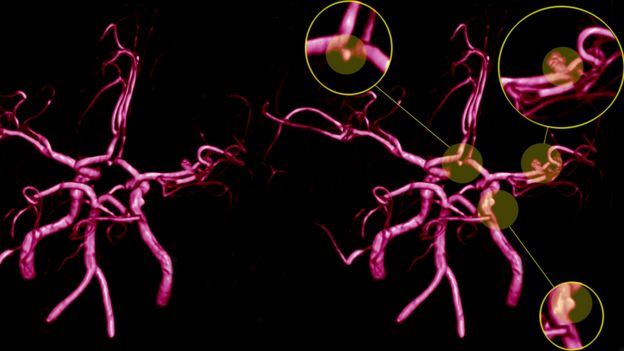Imagen de las neuronas durante un aneurisma cerebral.