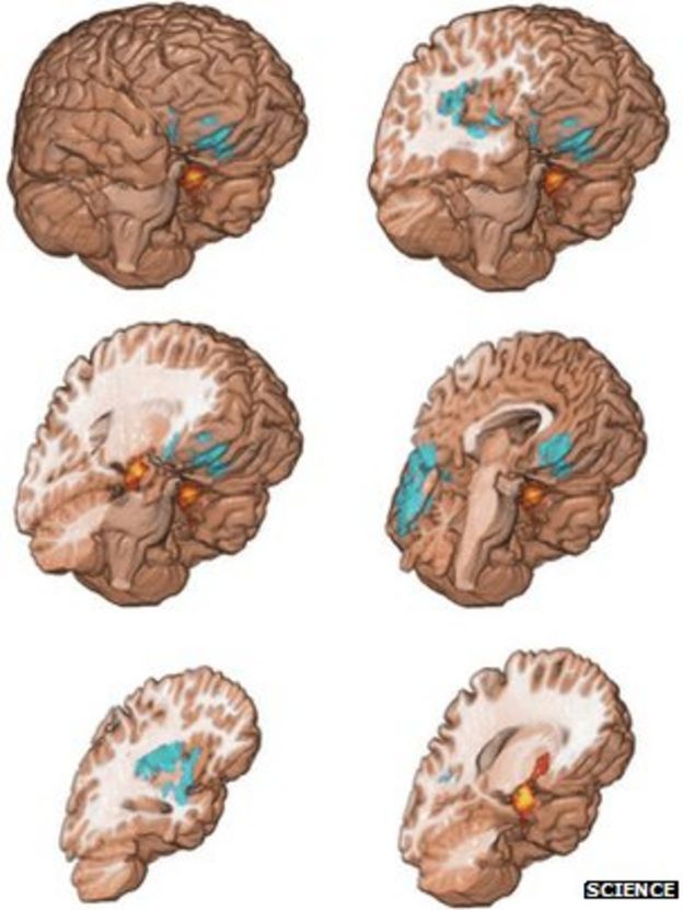 Brains may be wired for addiction BBC News