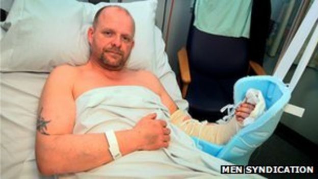 Surgeons save man's arm cut off in saw accident - BBC News