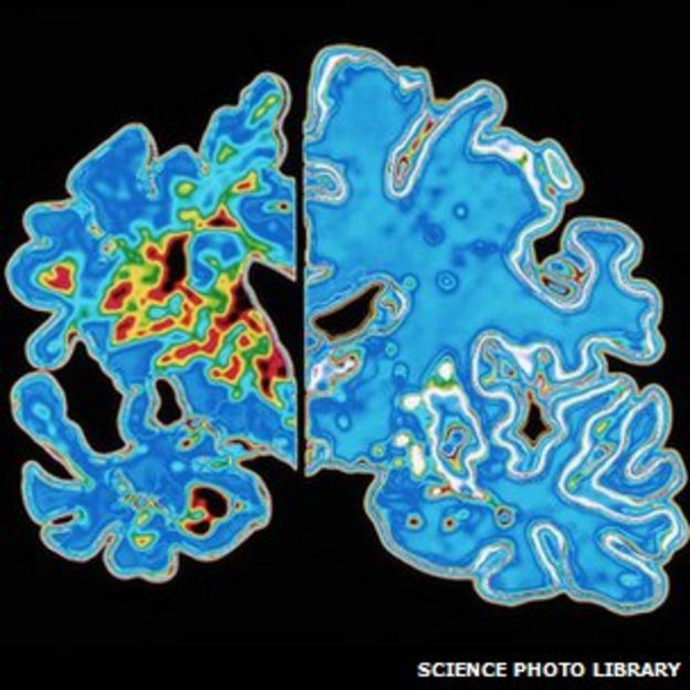 Alzheimers Reversal Scientists Discover 2 Existing Drugs That Work In Mice - 8cv3sjp
