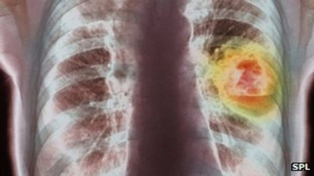 Industrial diseases: Call to recover treatment cost from business - BBC