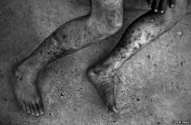 Multiple track marks from injecting heroin are seen in the legs of a Mexican man in Ciudad Juarez