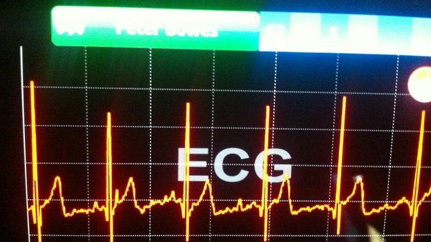 Electrocardiagram