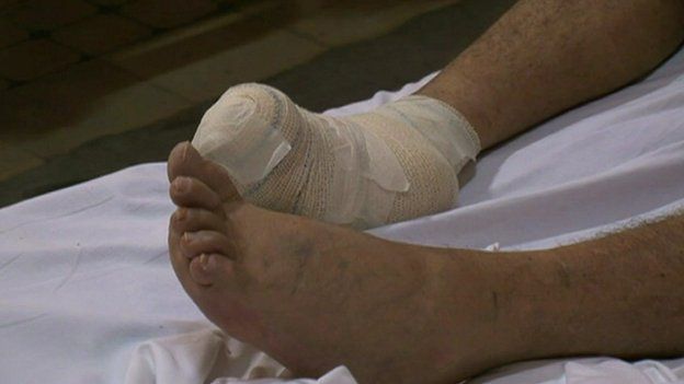 Leprosy sufferer's feet