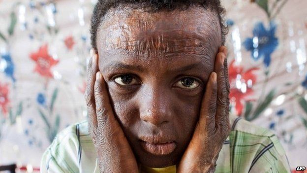 Suleiman Fatul Saim, 10, from Dar al-Salam in North Darfur, posing for a picture in El-Fasher, the administrative capital of North Darfur, on April 2, 2013. Suleiman suffered burns to more than 90 percent of his body when his brother detonated a device found near their house in November 2006