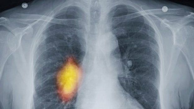 A chest X-ray showing cancer in the right lung.