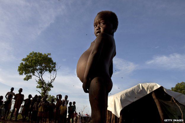 A young boy suffering from malnutrition