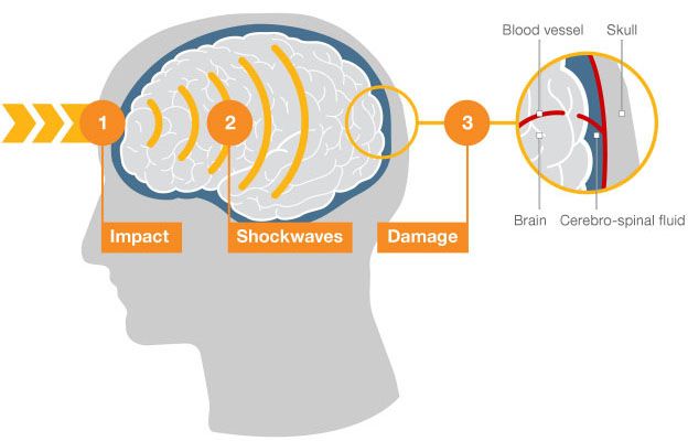 How Dangerous Is A Blow To The Head BBC News