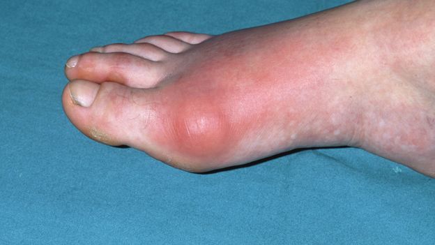 Foot with gout