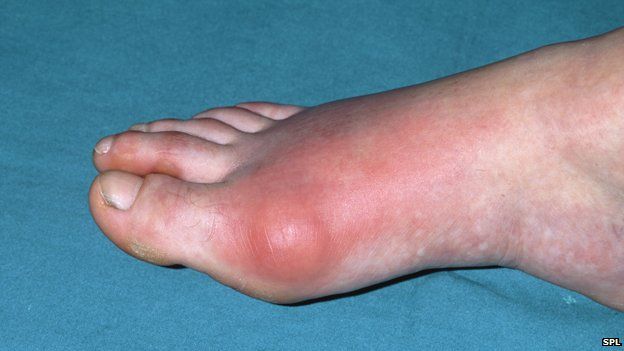 Foot with gout