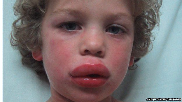 A young boy with a rash a swollen lip