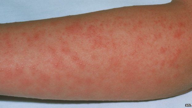 scarlet fever rash