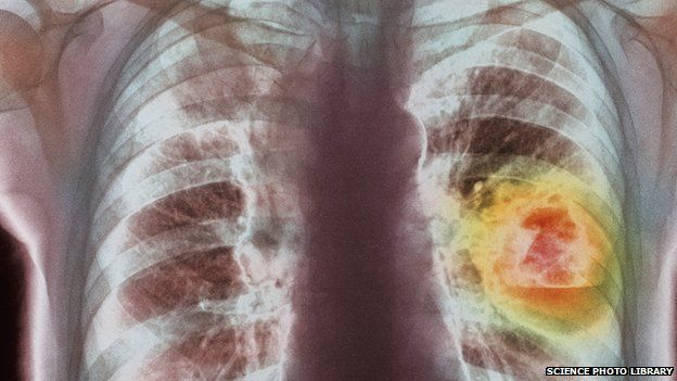 Coloured chest X-ray showing lung cancer