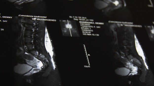 MRI scan that shows a large area of silicon in the patient's back