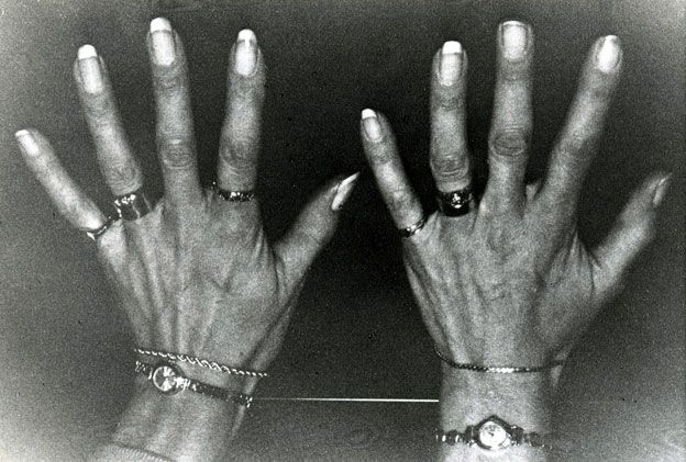 Reared-apart British twins' long, slender hands and fingers, showing their shared taste for jewellery.
